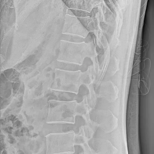 Radiographie de la colonne vertébrale