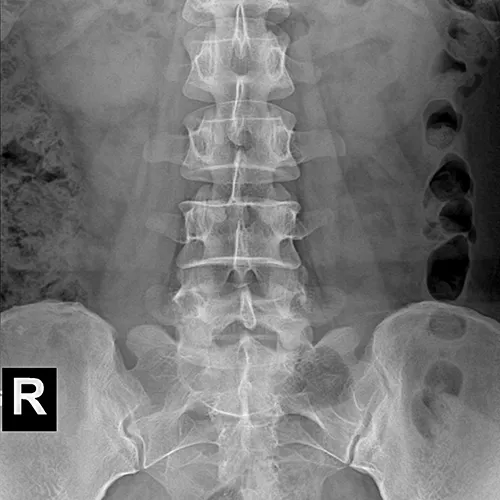 Radiographie abdominale 