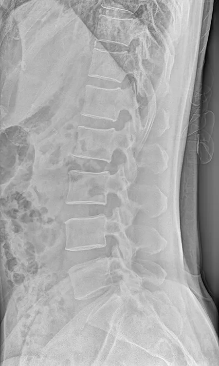  Radiographie lombaire