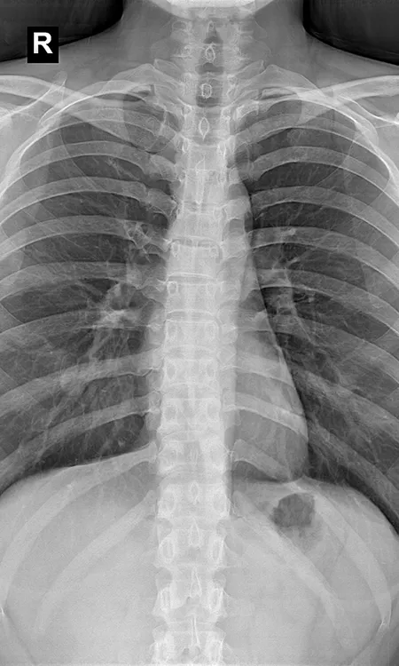 Radiographie thoracique