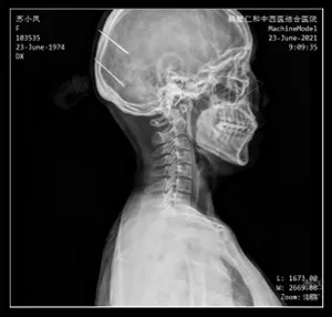 Système de radiographie monté au plafond
