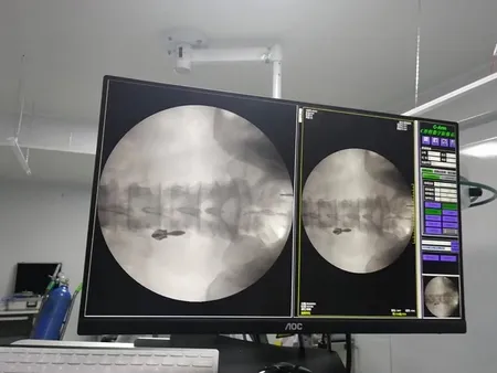 Arceau chirurgical mobile avec amplificateur de brillance