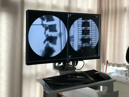 Arceau chirurgical mobile avec amplificateur de brillance
