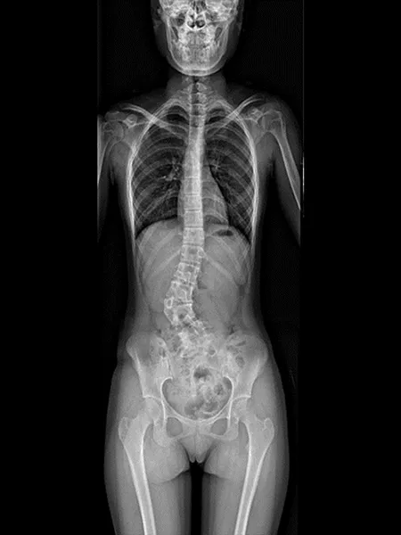 Radiographie de couture des os longs