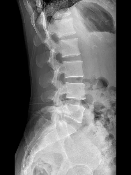 Radiographie latérale de la colonne vertébrale