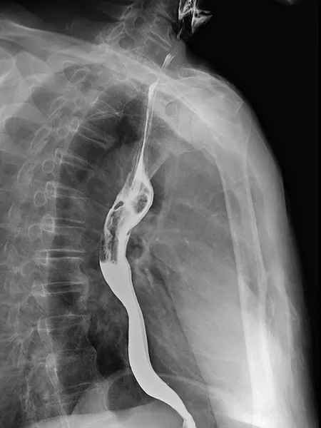 Radiographie de l’œsophage