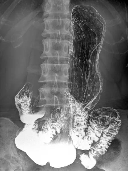 Radiographie de l’estomac