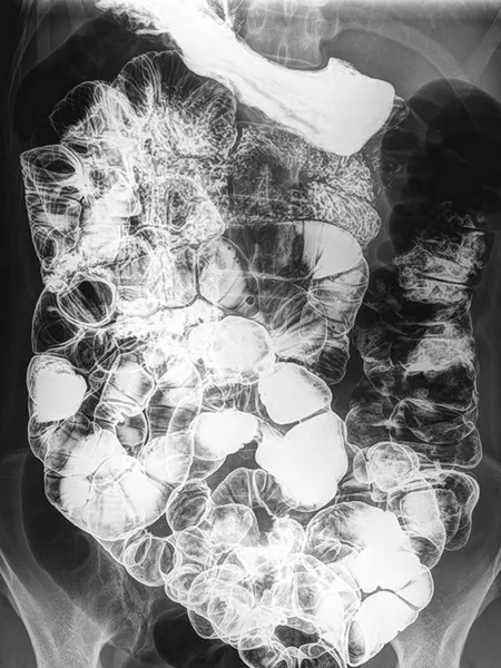 Radiographie de l’intestin grêle